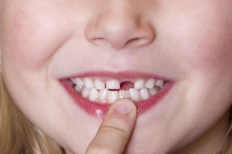 Điềm báo chiêm bao rụng răng